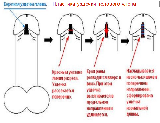 Пластика уздечки полового члена