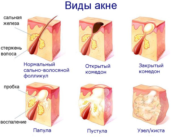 виды акне