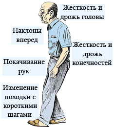 симптомы болезни Паркинсона