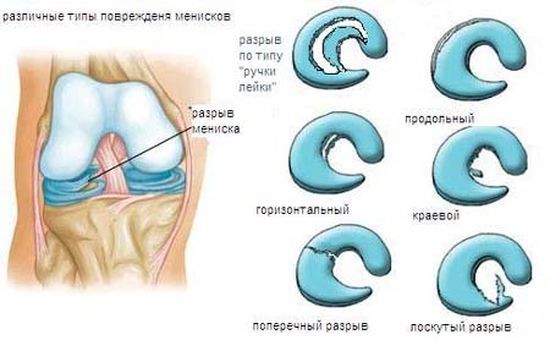 повреждение мениска