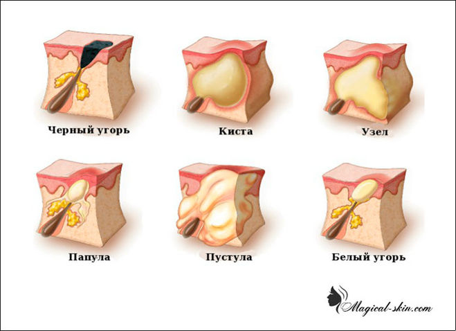 виды акне изнутри