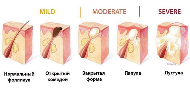 комедоны